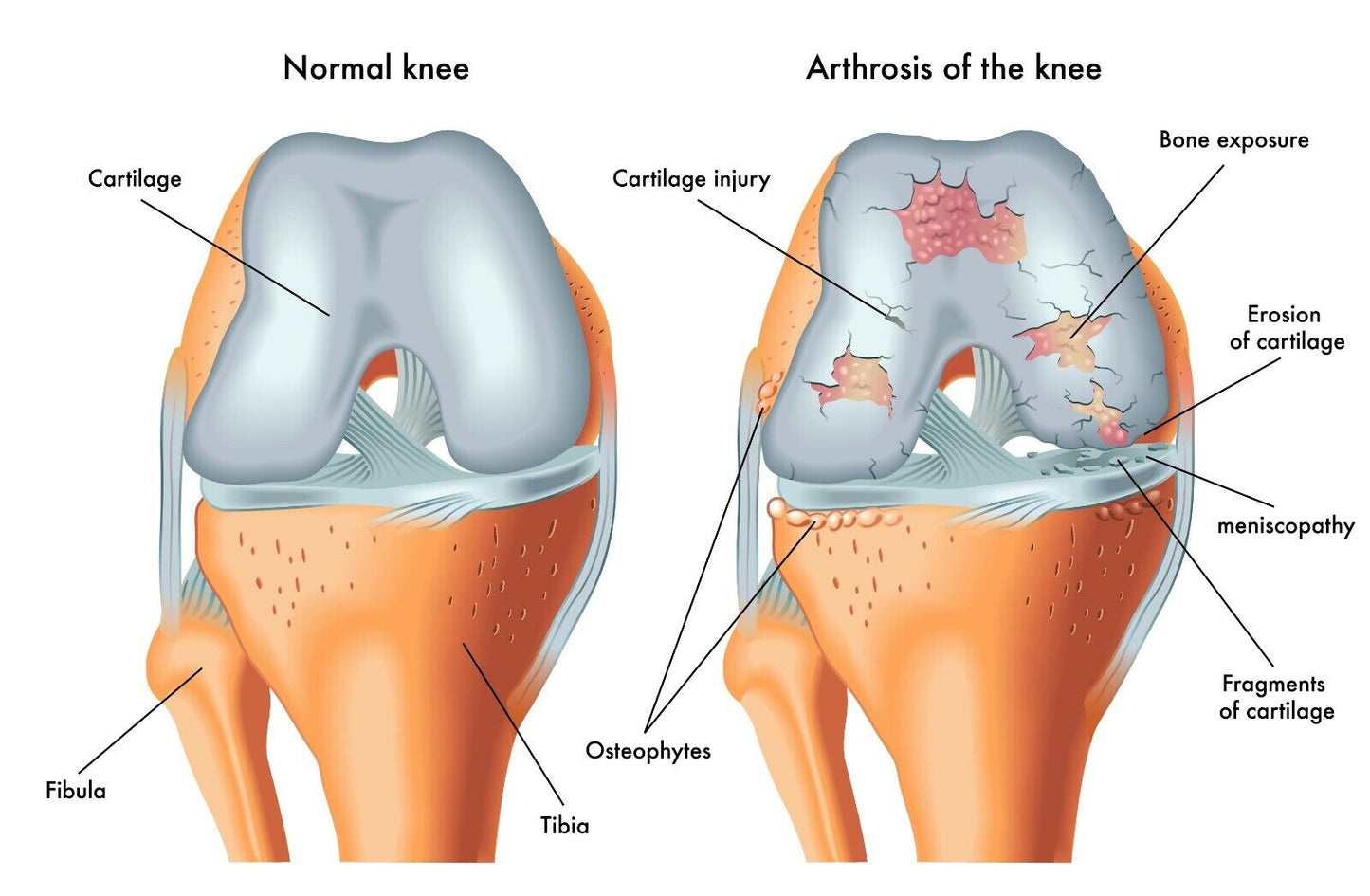 Osteoarthritis Cream Joint Knee Hip Fingers Pain Relief Fibromyalgia Flare Up