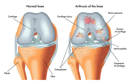 Osteoarthritis Cream Joint Knee Hip Fingers Pain Relief Fibromyalgia Flare Up