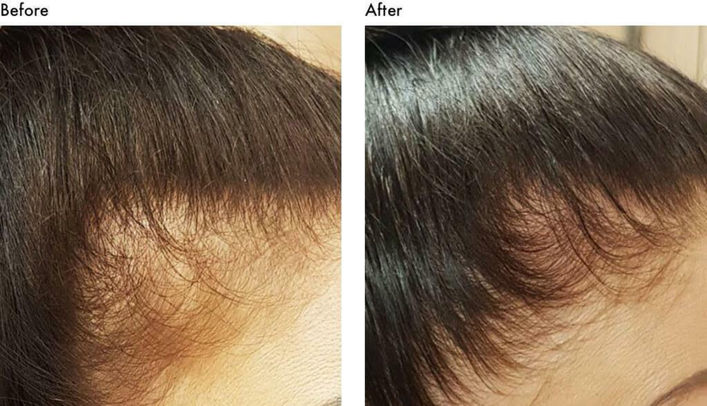 Onion & Garlic Thickening & Growth Hair Oil Treatment-Thin