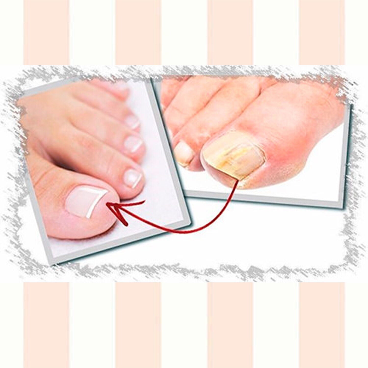 Onyсhomyc the Best Nail Fungus Non -Pharmacologic