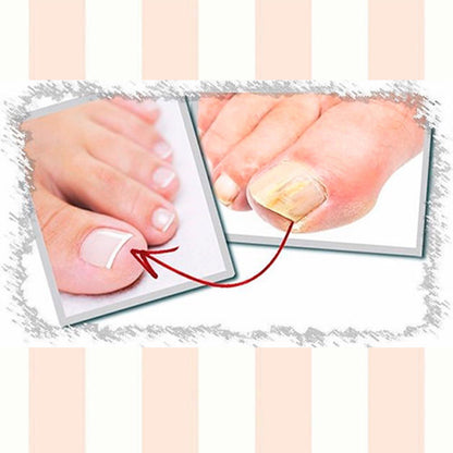 Onyсhomyc the Best Nail Fungus Non -Pharmacologic